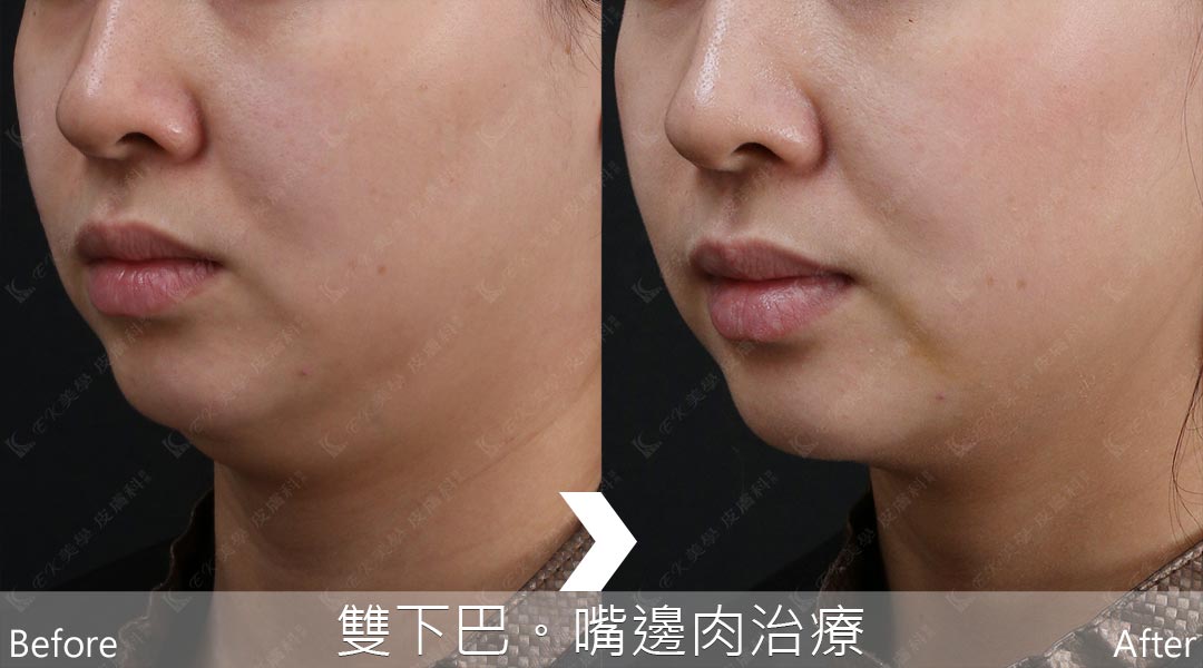 AGNES(集效電波)克文史森電刀系統雙下巴治療案例照