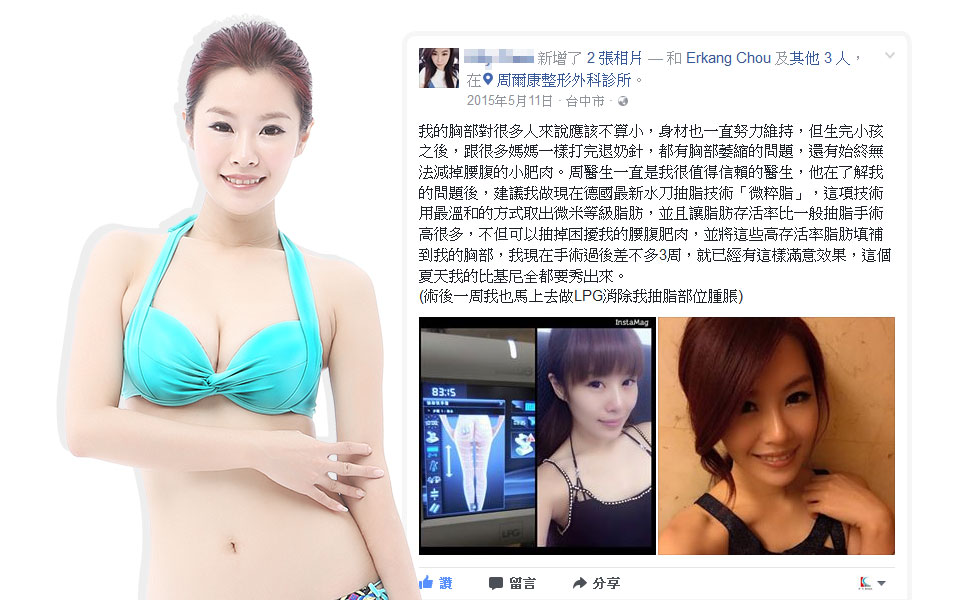 微粹脂自體脂肪移植豐額填補夫妻宮蘋果肌豐頰案例1