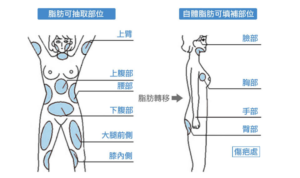 自體脂肪隆乳(豐胸)|自體脂肪隆乳案例|台中自體脂肪隆乳|種子教官醫師執刀