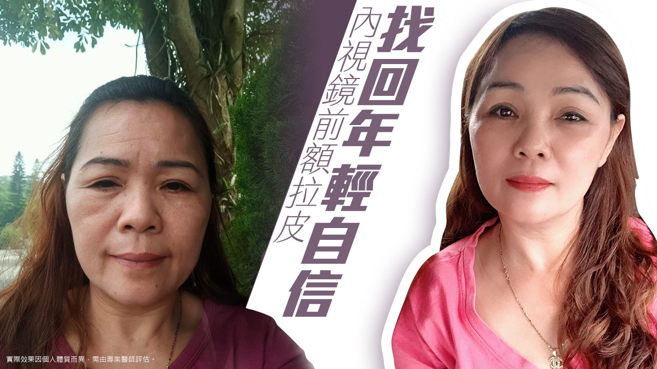 微創五爪八爪前額內視鏡拉皮手術