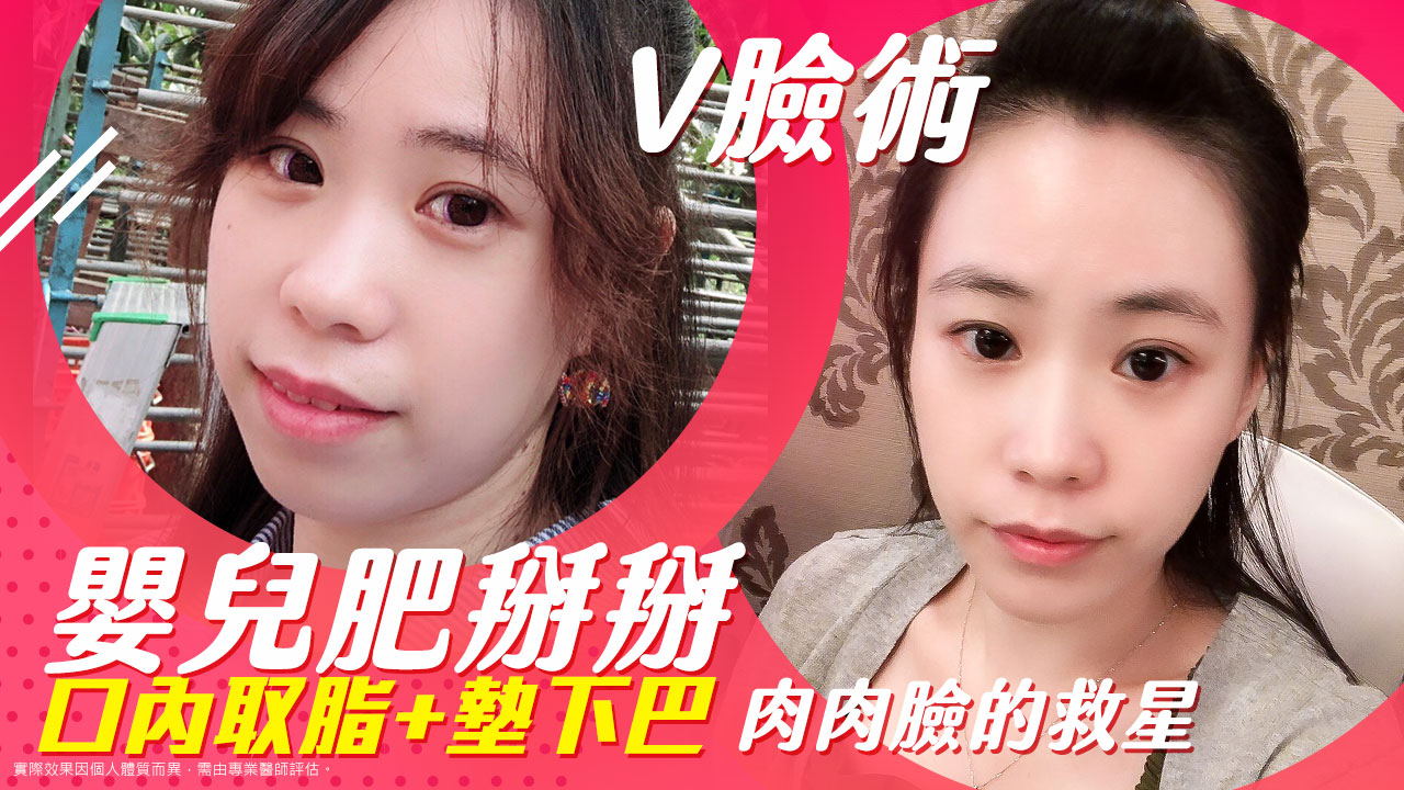 原廠認證電漿學院|2025氦氣電漿是什麼?術後效果如何?艾皮克斯電燒系統|改善皮膚鬆弛問題