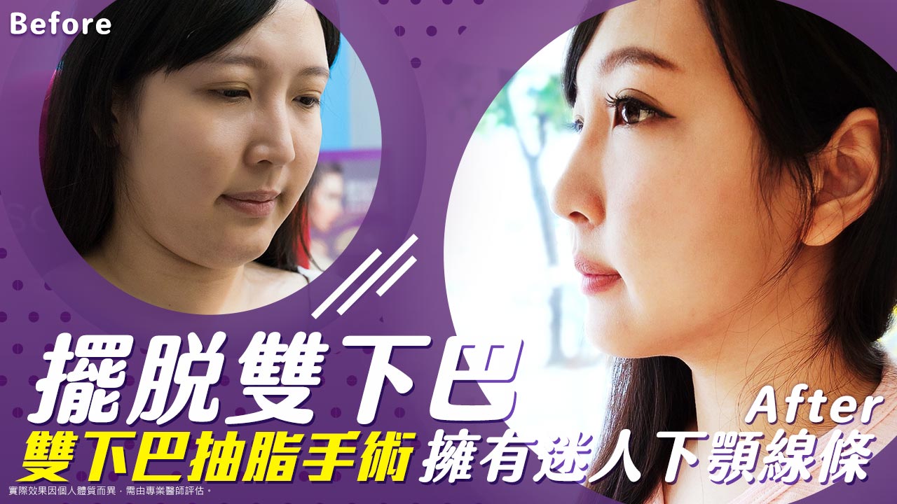 原廠認證電漿學院|2025氦氣電漿是什麼?術後效果如何?艾皮克斯電燒系統|改善皮膚鬆弛問題