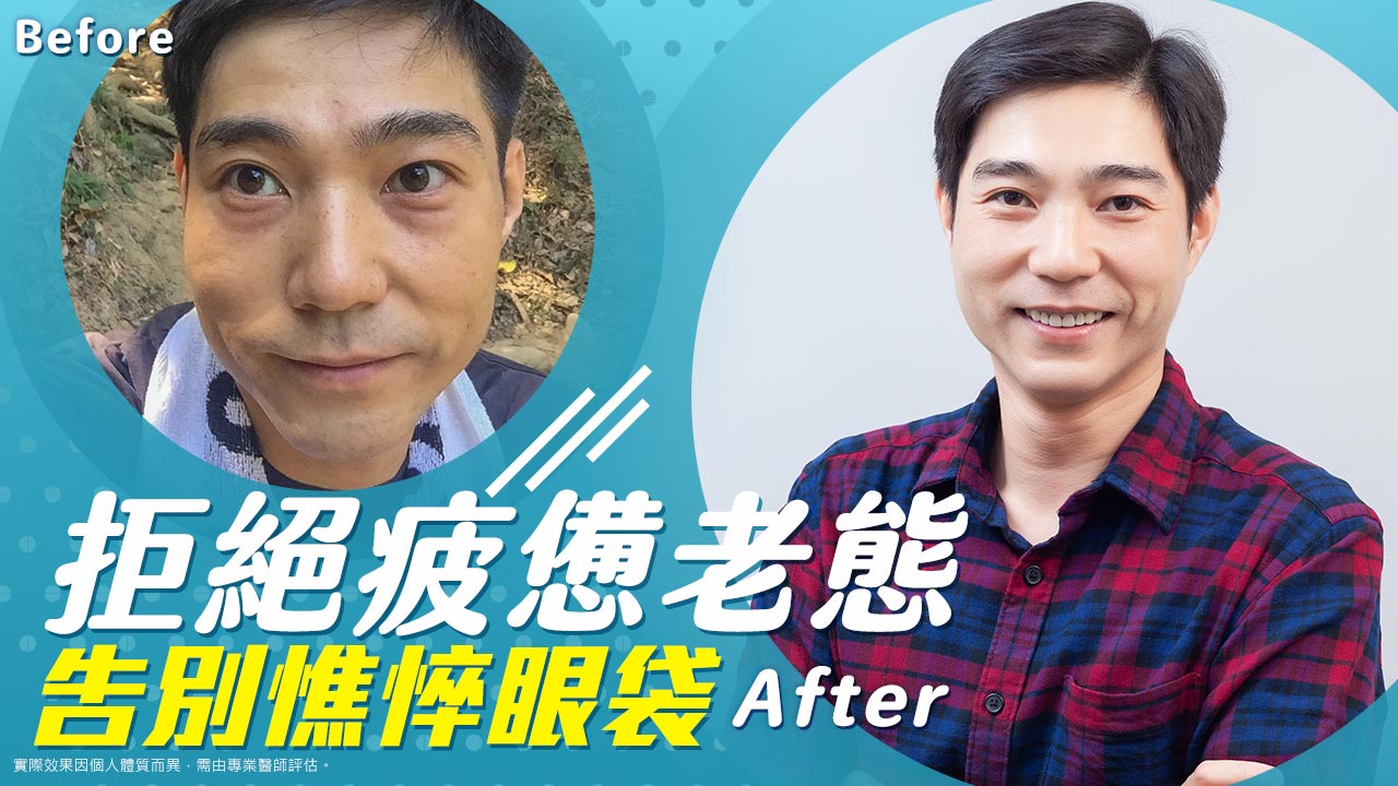 原廠認證電漿學院|2025氦氣電漿是什麼?術後效果如何?艾皮克斯電燒系統|改善皮膚鬆弛問題