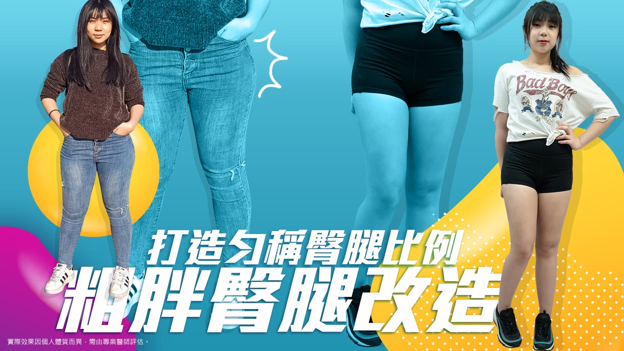 【舊版】大腿抽脂∣大腿抽脂肪手術方式、費用、副作用、案例分享、恢復期、風險