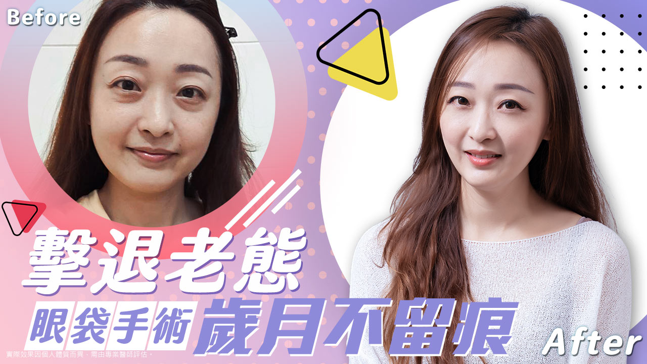 雙眼皮割的好還是縫的好？雙眼皮手術必須知道的幾件事情！！feat.林永祥醫師