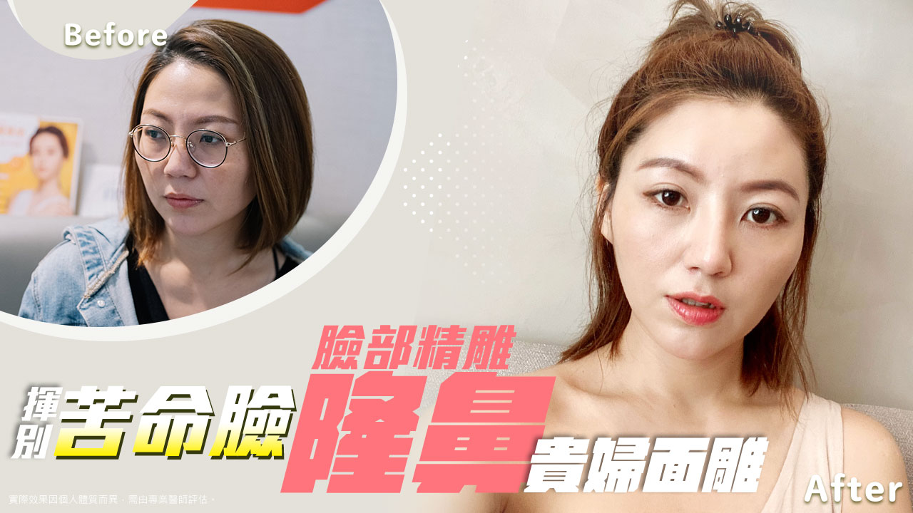 隆鼻手術∣三段式隆鼻∣埋線隆鼻∣玻尿酸隆鼻∣打造精緻高挺鼻∣五官深邃立體
