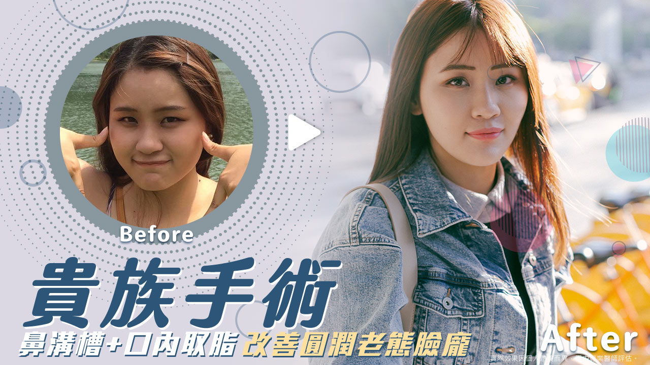 口內取脂,消除嬰兒肥臉型|重回V字臉