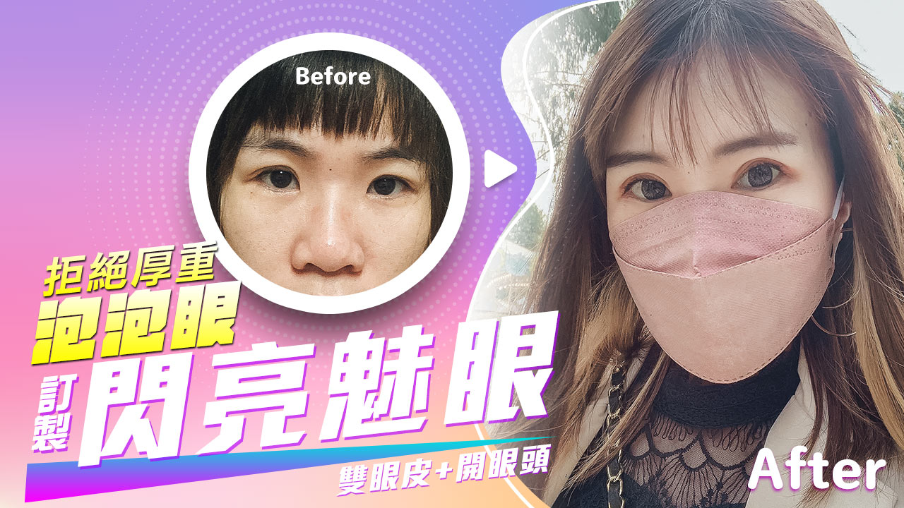 隱痕開眼頭/開眼尾。魅力電眼不留痕跡