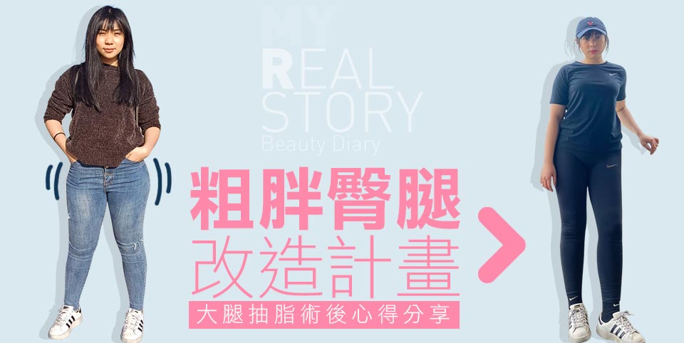 大腿抽脂心得分享 – 威塑Vaser4D 大腿抽脂 PAL飆塑動力抽脂
