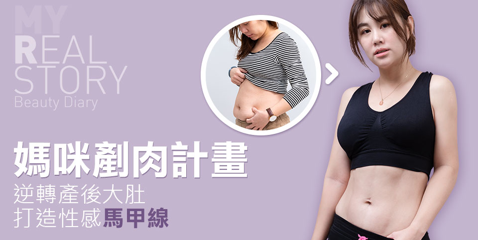 腹部抽脂手術後心得分享，找回產前身形∣台中抽脂權威