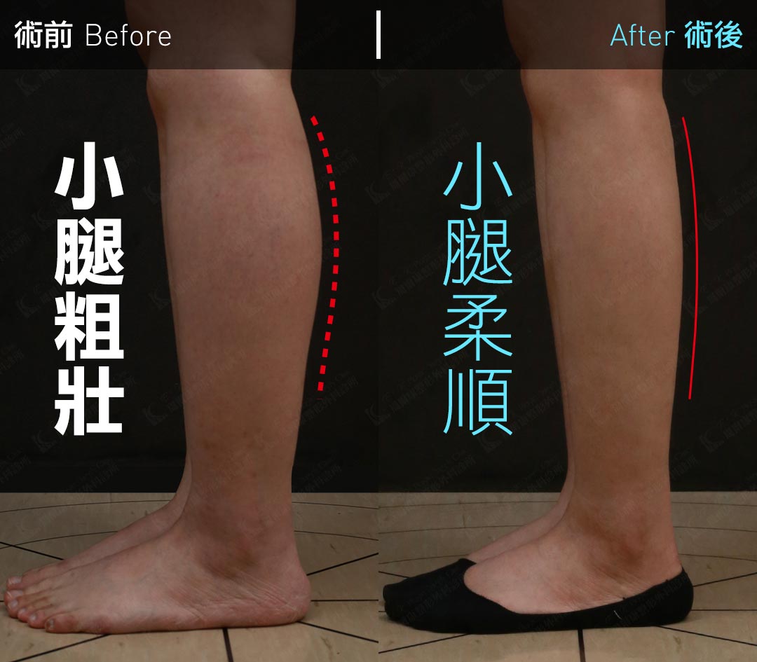 周爾康醫師小腿抽脂案例術前術後對比照-04