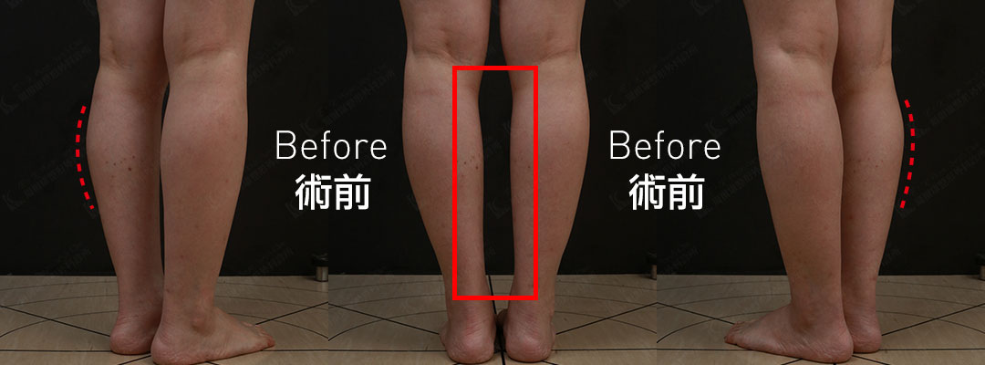 周爾康醫師小腿抽脂案例術前術後對比照-05