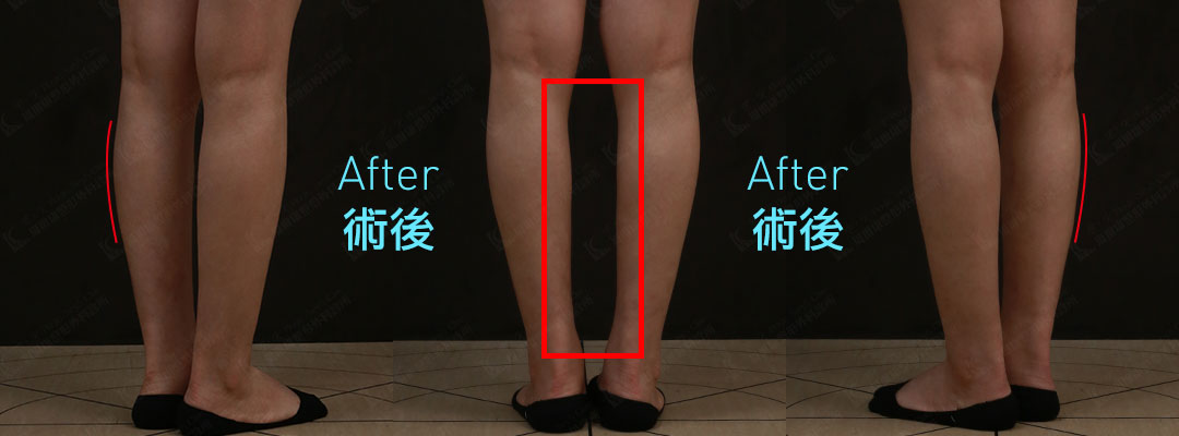 周爾康醫師小腿抽脂案例術前術後對比照-06