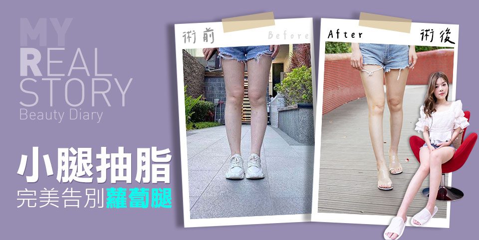 小腿抽脂手術後心得分享，擺脫蘿蔔腿∣台中抽脂權威
