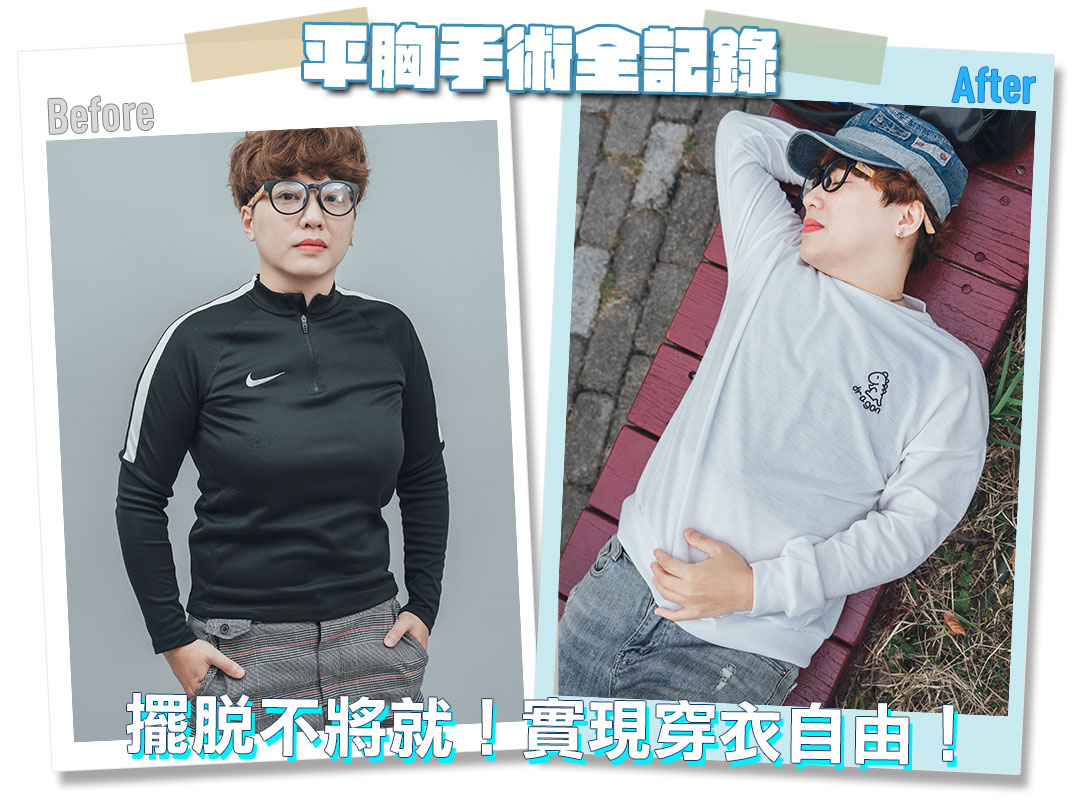 平胸手術分享心得｜平胸手術推薦｜甜甜圈式平胸手術｜台中平胸手術推薦診所