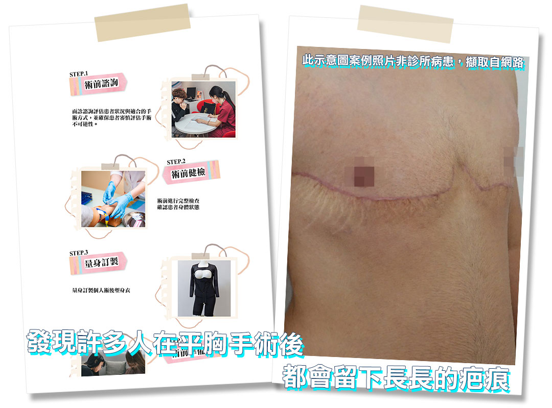 平胸手術分享心得｜平胸手術推薦｜甜甜圈式平胸手術｜台中平胸手術推薦診所