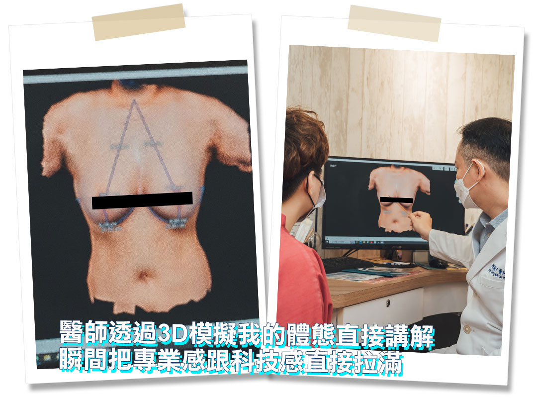 平胸手術分享心得｜平胸手術推薦｜甜甜圈式平胸手術｜台中平胸手術推薦診所
