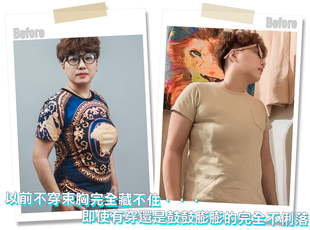 平胸手術分享心得｜平胸手術推薦｜甜甜圈式平胸手術｜台中平胸手術推薦診所