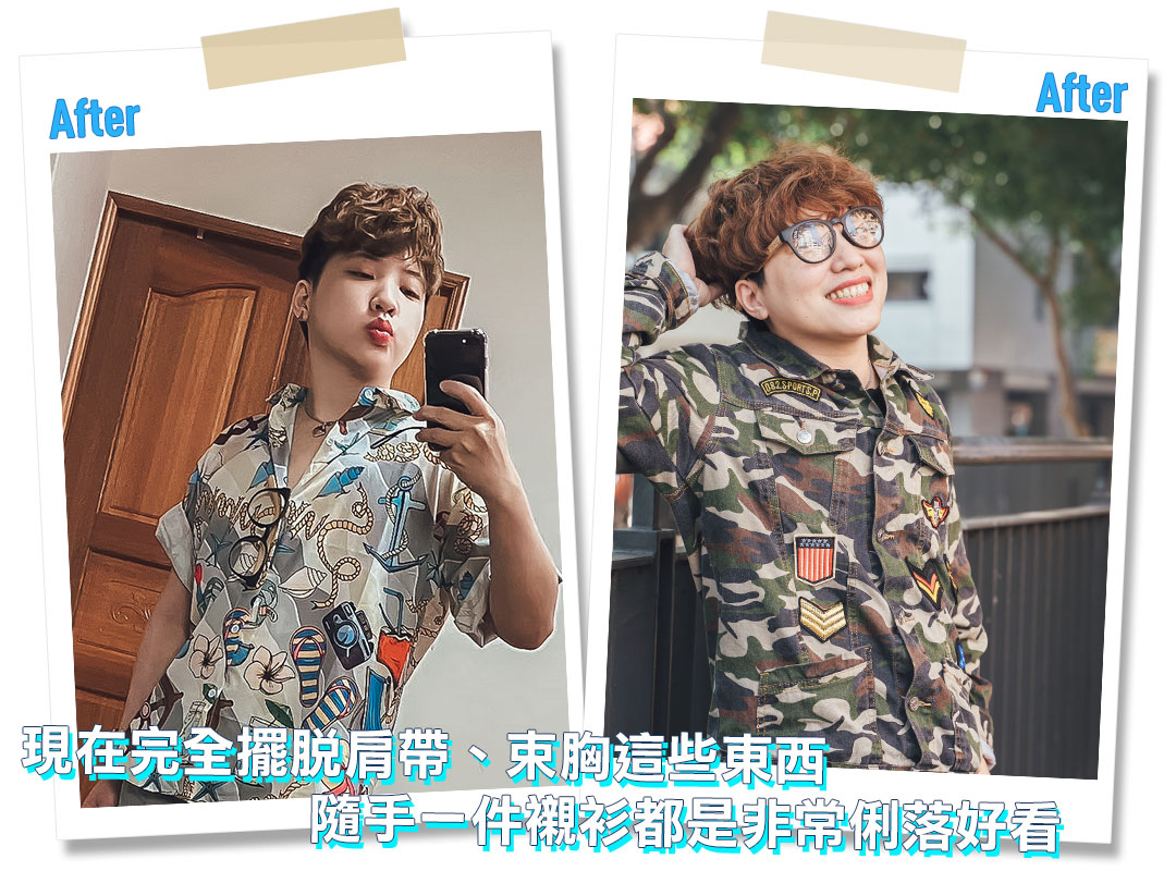 平胸手術分享心得｜平胸手術推薦｜甜甜圈式平胸手術｜台中平胸手術推薦診所
