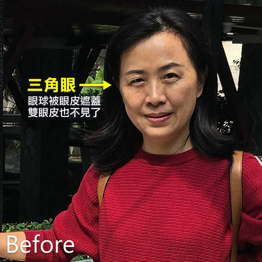 周爾康整形外科診所內視鏡前額拉皮案例術前照-02