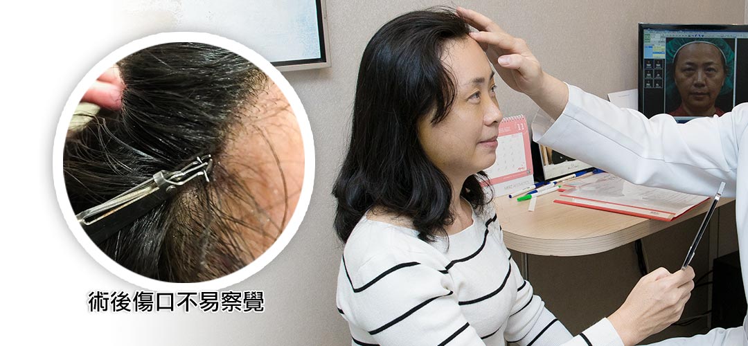 周爾康整形外科診所內視鏡前額拉皮案例術後照