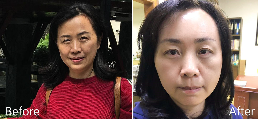 周爾康整形外科診所內視鏡前額拉皮案例術前術後對比照