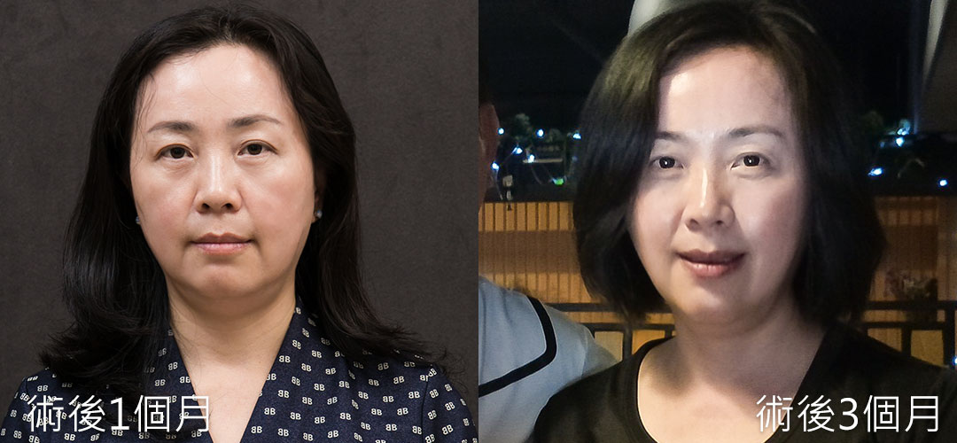 周爾康整形外科診所醫師內視鏡前額拉皮案例術後1-3個月對比照
