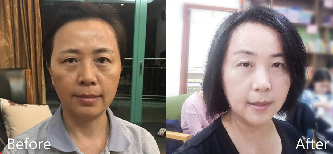 周爾康整形外科診所內視鏡前額拉皮案例術前術後對比照