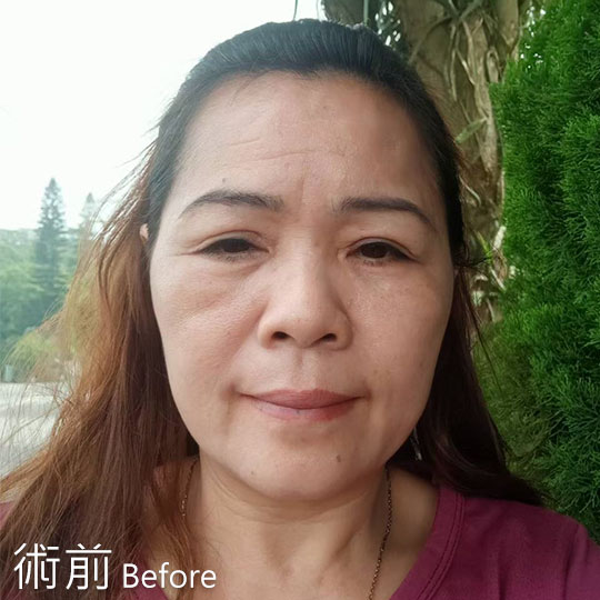 周爾康整形外科內視鏡前額拉皮案例術前照