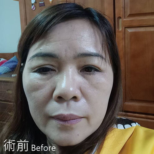 周爾康整形外科內視鏡前額拉皮案例術前照