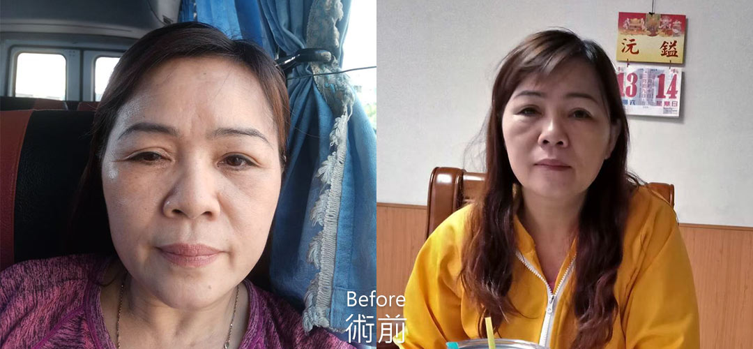 周爾康整形外科內視鏡前額拉皮案例術前照