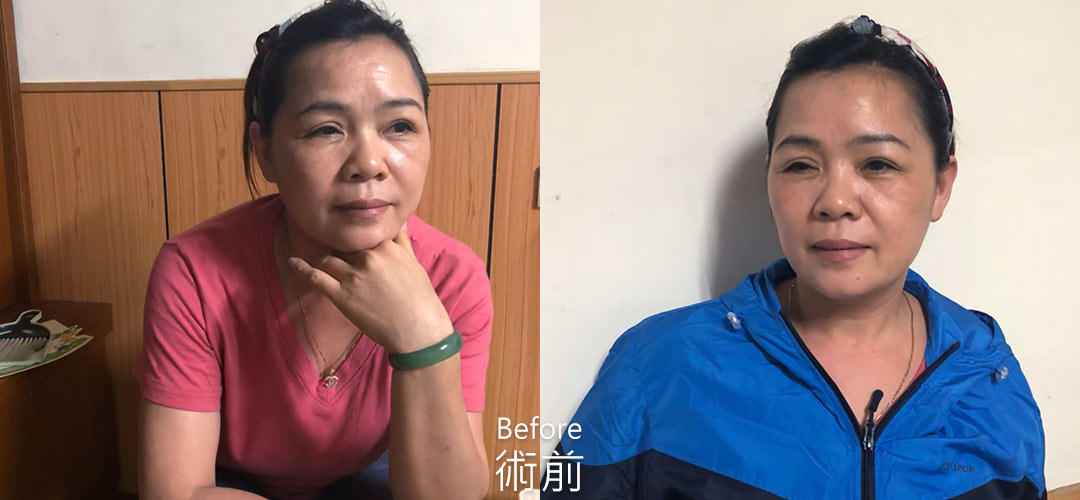 周爾康整形外科內視鏡前額拉皮案例術前諮詢照
