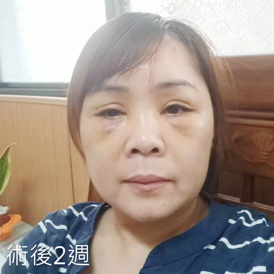 周爾康整形外科內視鏡前額拉皮案例術後照