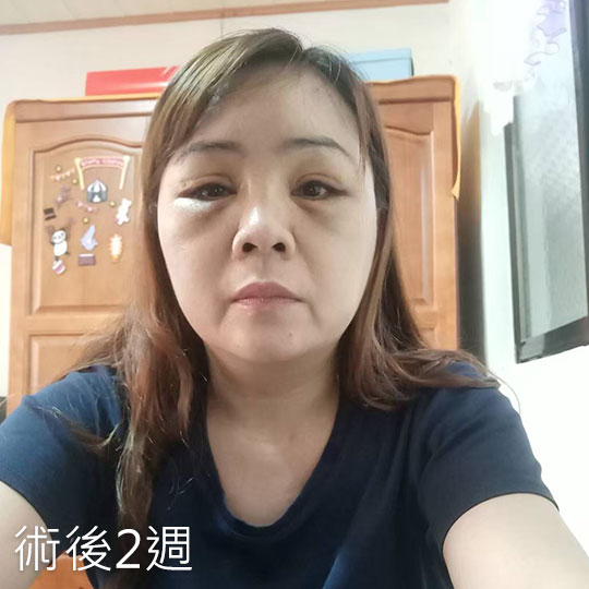 周爾康整形外科內視鏡前額拉皮案例術後照