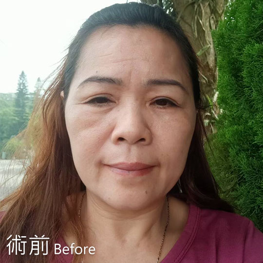 周爾康整形外科內視鏡前額拉皮案例術前照