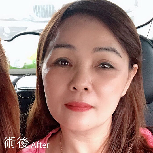 周爾康整形外科內視鏡前額拉皮案例術後照