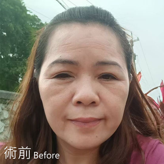 周爾康整形外科內視鏡前額拉皮案例術後照