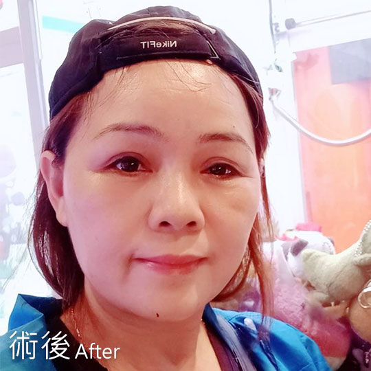 周爾康整形外科內視鏡前額拉皮案例術後照