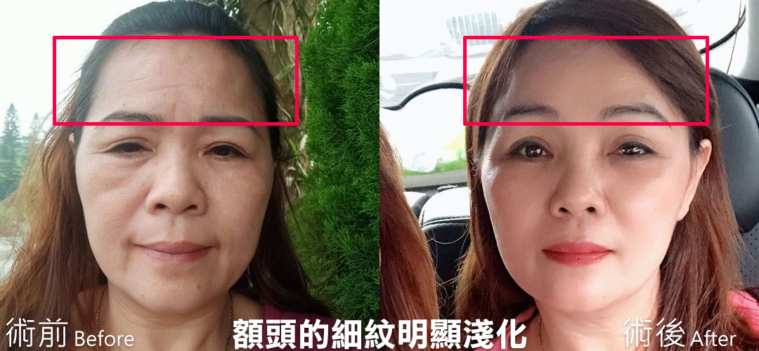 周爾康整形外科內視鏡前額拉皮案例術前術後照抬頭紋對比