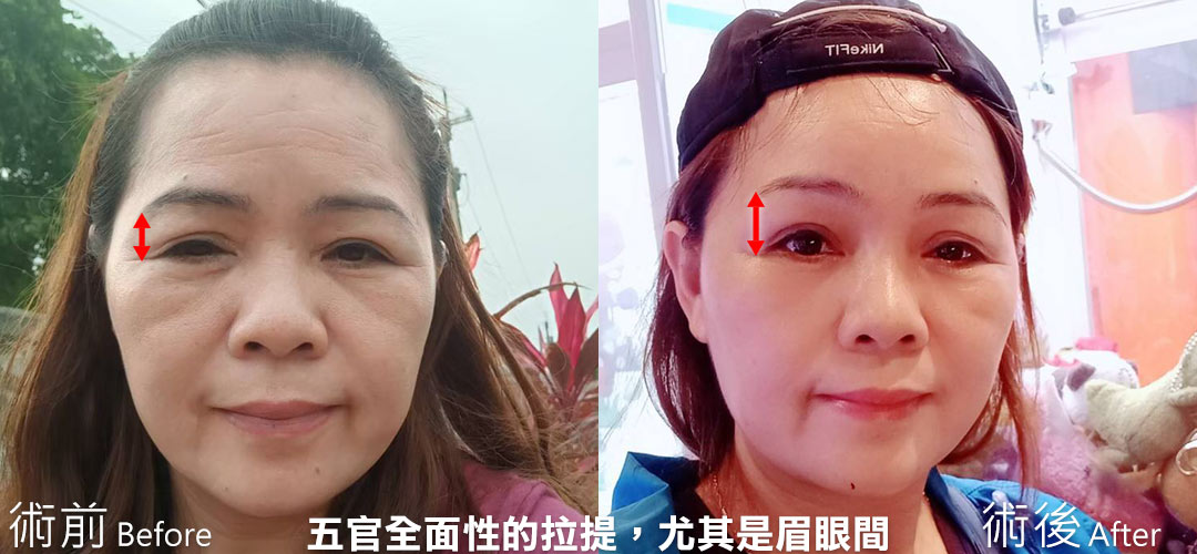周爾康整形外科內視鏡前額拉皮案例術前術後照抬頭紋對比