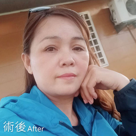 周爾康整形外科內視鏡前額拉皮案例術前術後照抬頭紋對比
