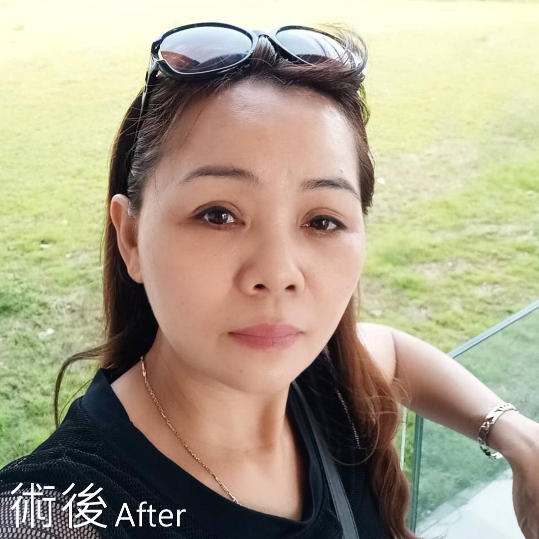 周爾康整形外科內視鏡前額拉皮案例術前術後照抬頭紋對比