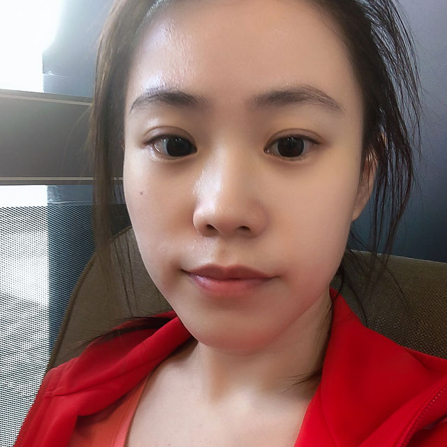 瘦小臉案例-口內取脂/墊下巴