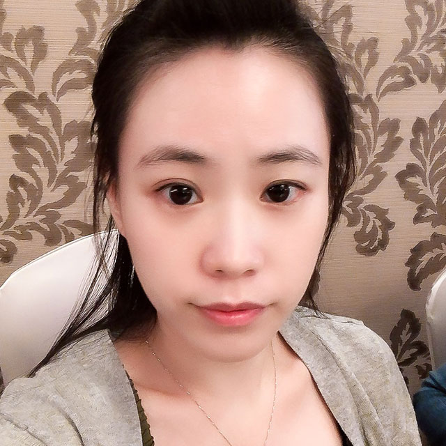 瘦小臉案例-口內取脂/墊下巴