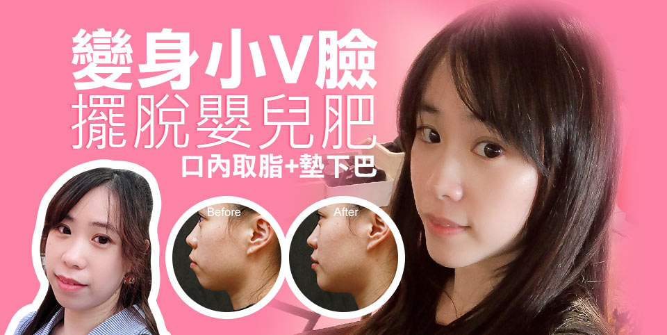 瘦小臉案例-口內取脂/墊下巴
