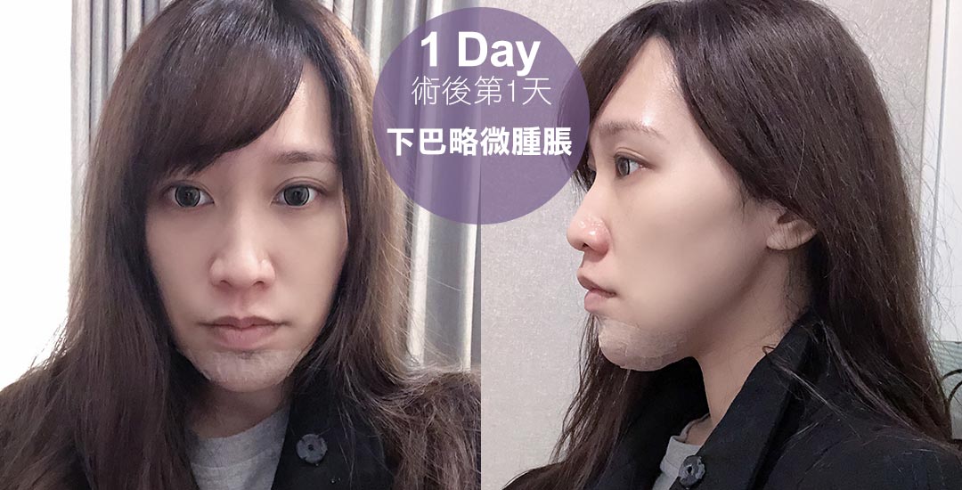 打造精緻臉龐-墊下巴手術