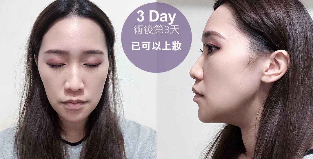 打造精緻臉龐-墊下巴手術