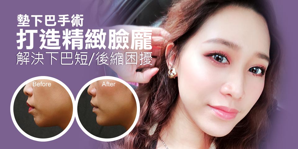 打造精緻臉龐-墊下巴手術
