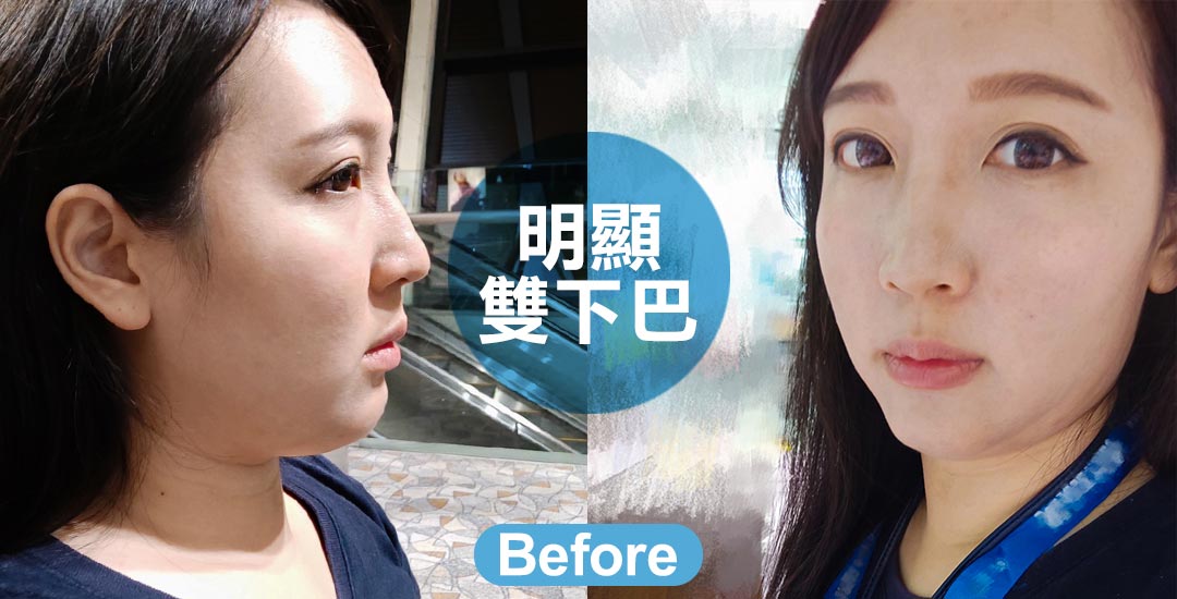 擺脫雙下巴。擁有迷人下顎線條