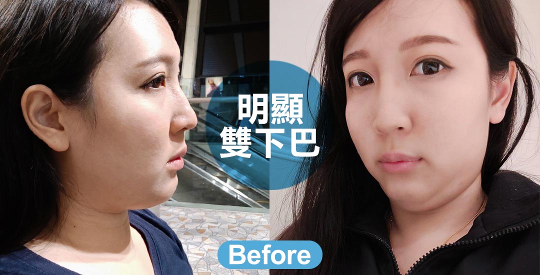 擺脫雙下巴。擁有迷人下顎線條
